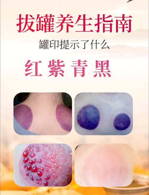 「健康解码」拔罐后皮肤颜色深就是身体差?真相是……